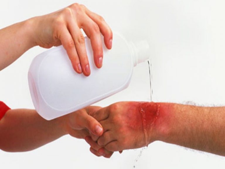 Cómo curar una quemadura