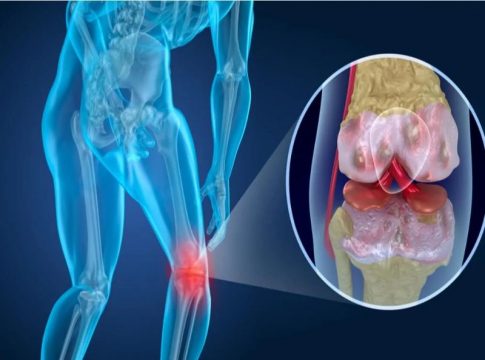 que es la artrosis portada que es la artrosis