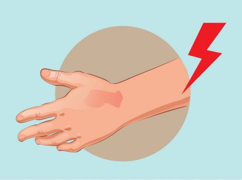 quemaduras 1 Cómo curar las quemaduras