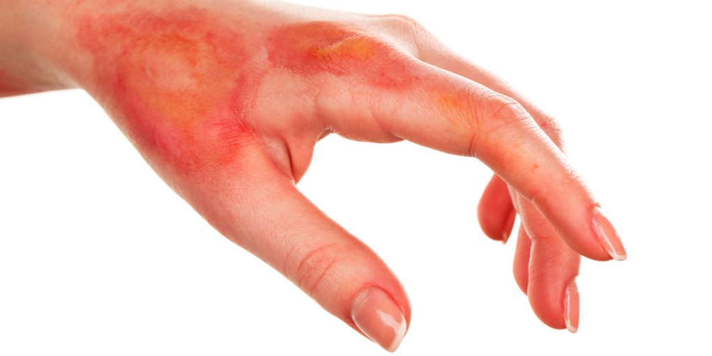 Cómo curar una quemadura 5 quemaduras