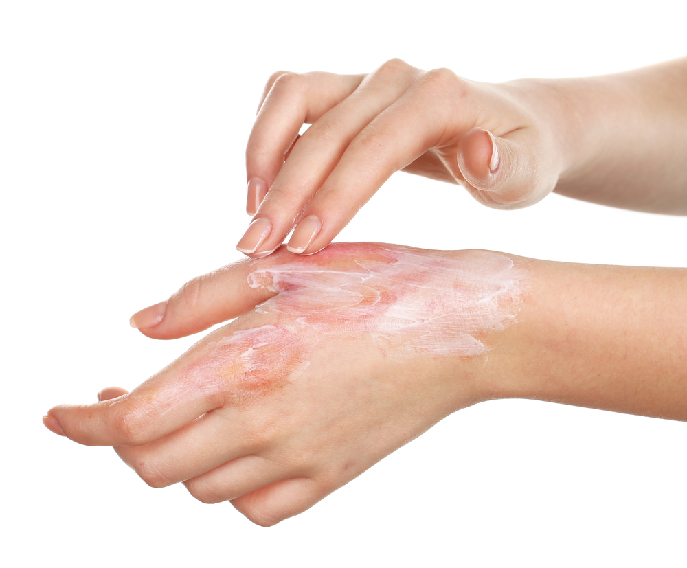 Cómo curar quemaduras 6 Tratamiento en quemaduras de primer grado