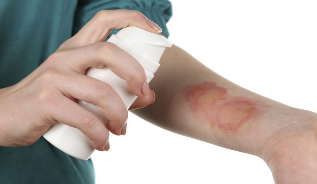 Cómo curar quemaduras 7 Tratamiento en quemaduras de segundo grado