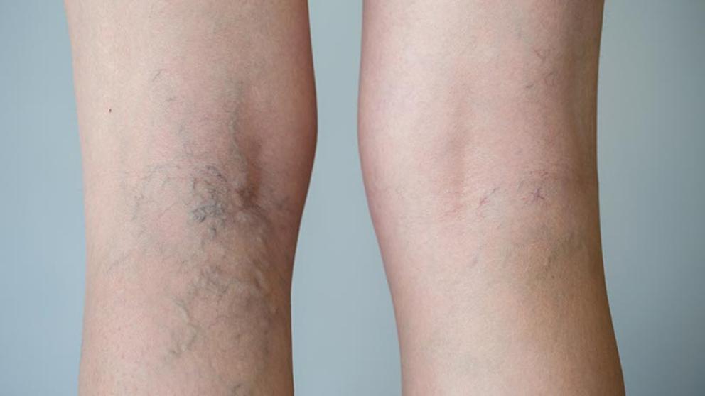 Síntomas del síncope