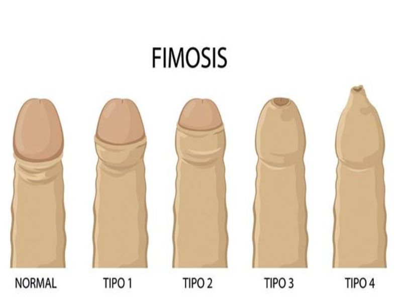Qué es la fimosis 2 tipos