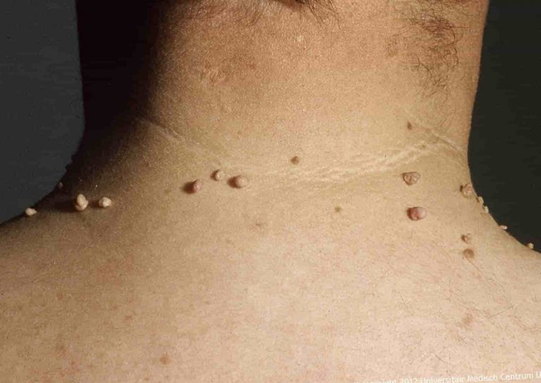 Cómo quitar verrugas