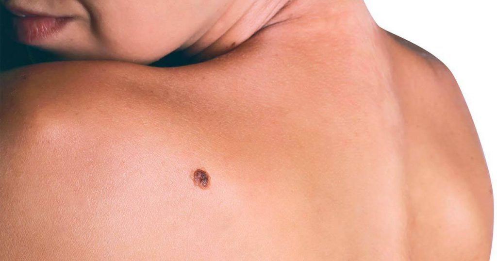 No todas las verrugas son problemáticas 