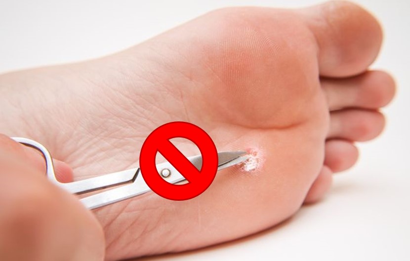 Lo que nunca hay que hacer con una verruga