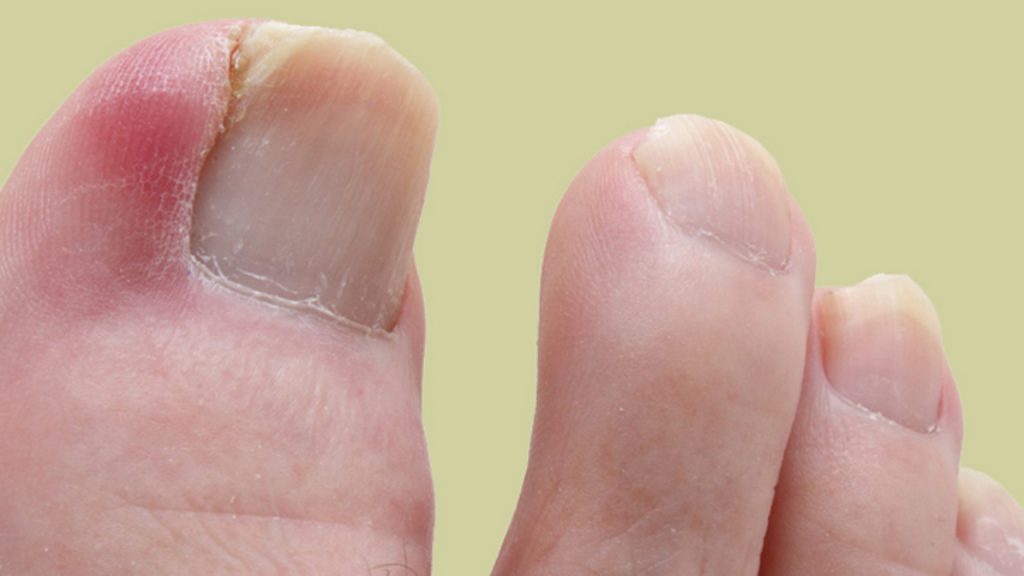 Cómo solucionar unas uñas encarnadas 1 Causas de las uñas encarnadas