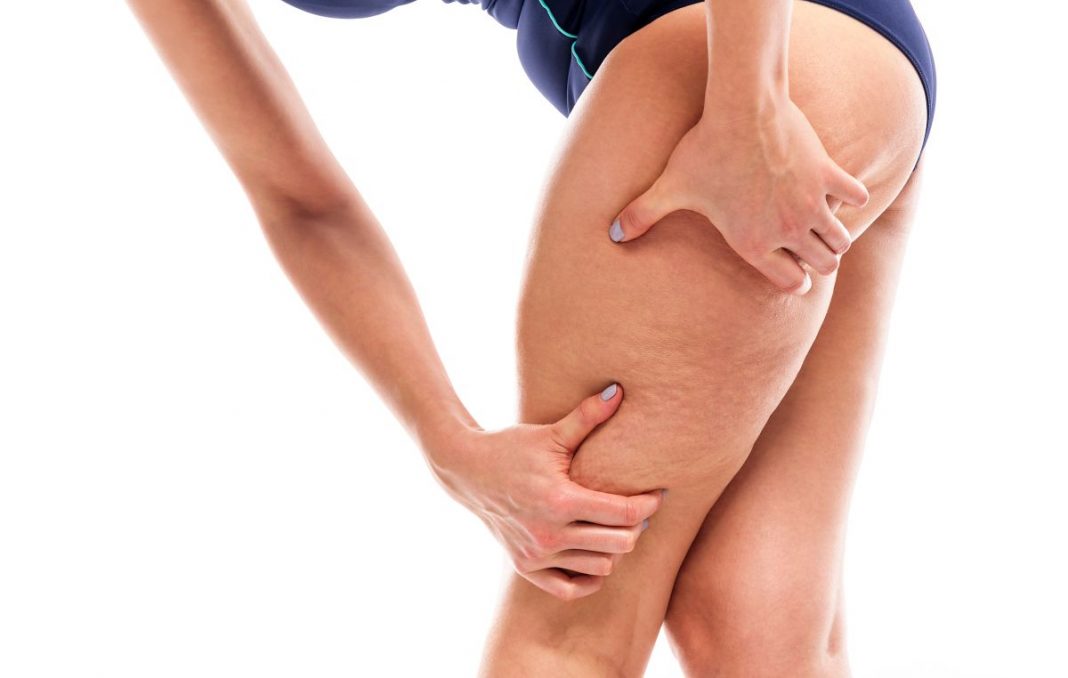 Celulitis: cómo tratarla y eliminarla de tu piel
