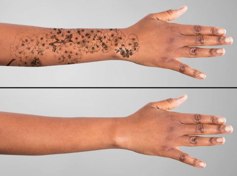 Cómo borrar un tatuaje: métodos que funcionan y son seguros Cómo borrar un tatuaje: métodos que funcionan y son seguros