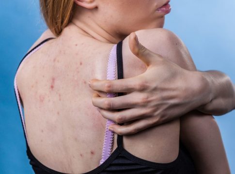 Cómo quitar la picazón del cuerpo: remedios caseros que funcionan Cómo quitar la picazón del cuerpo: remedios caseros que funcionan