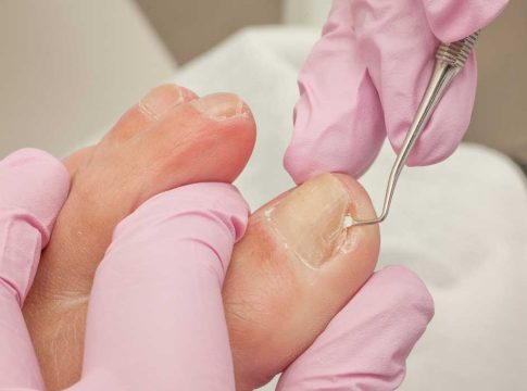 Cómo solucionar unas uñas encarnadas Cómo solucionar unas uñas encarnadas