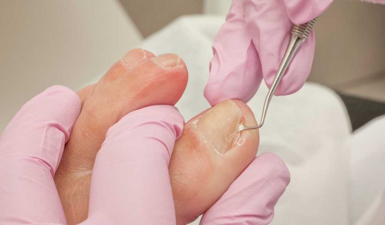 Cómo solucionar unas uñas encarnadas