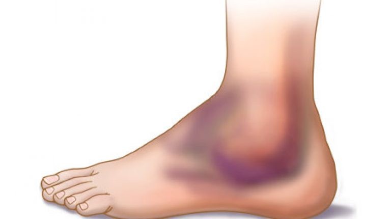 Cómo tratar un esguince