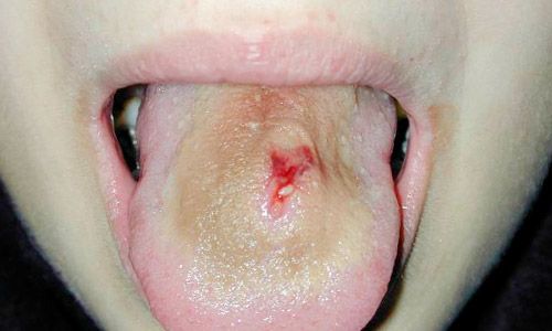 Sensibilidad y bacterias