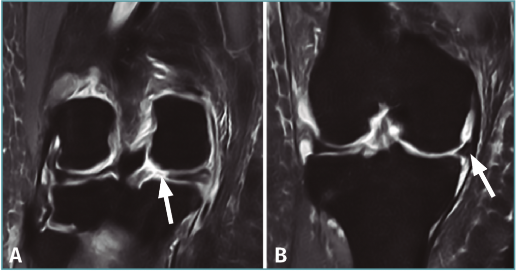 Qué es el menisco 8 ¿Que causa una lesión en el menisco?