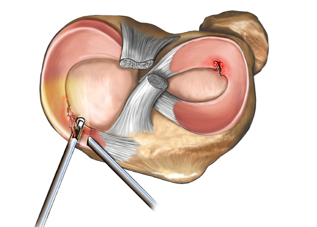 Qué es el menisco 7 Síntomas más comunes presente durante las lesiones de menisco