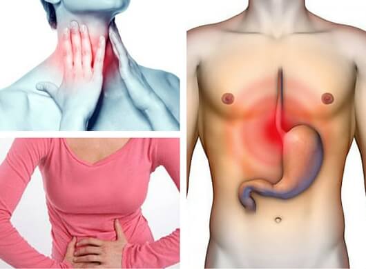 Síntomas del reflujo gástrico