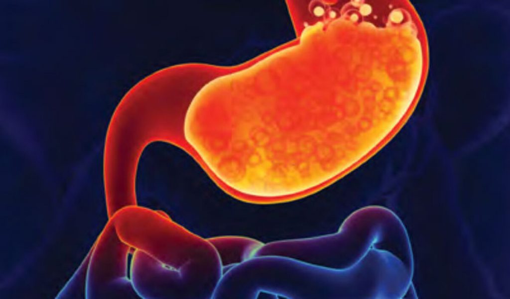 Otras cosas que tomar en cuenta para el reflujo gástrico