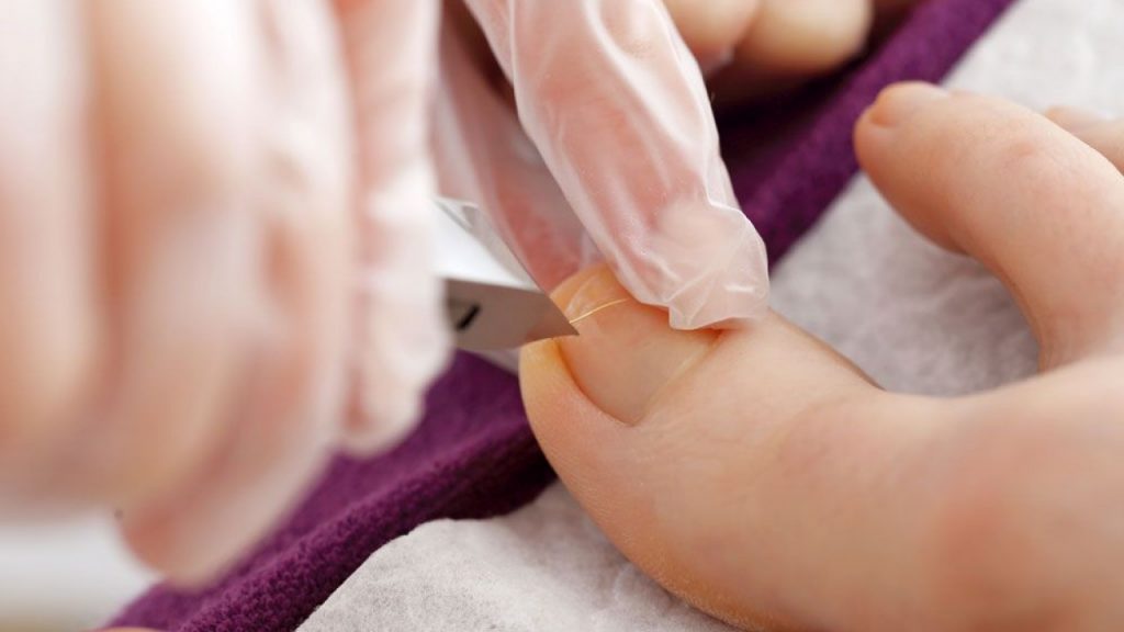 Cómo solucionar unas uñas encarnadas 4 Cirugía de avulsión de uñas