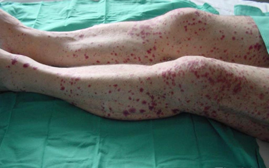 Qué es vasculitis 2 ¿Cuáles son los síntomas generales de la vasculitis?