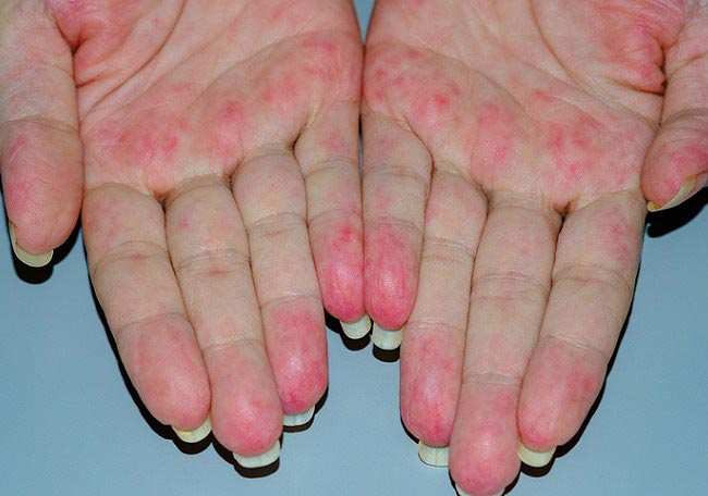 Qué es vasculitis 1 Causas de la afección