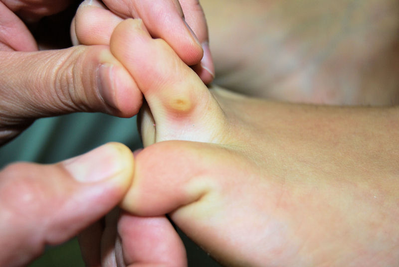 Tipos y clasifican: durezas o helomas