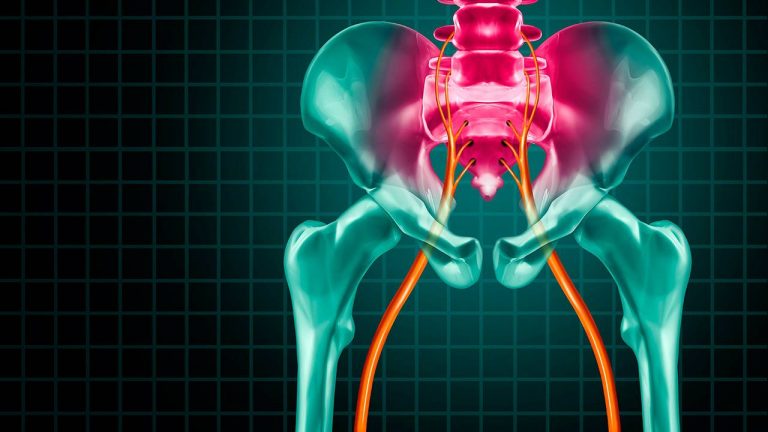 Ciática: así te avisa tu cuerpo de que algo va mal