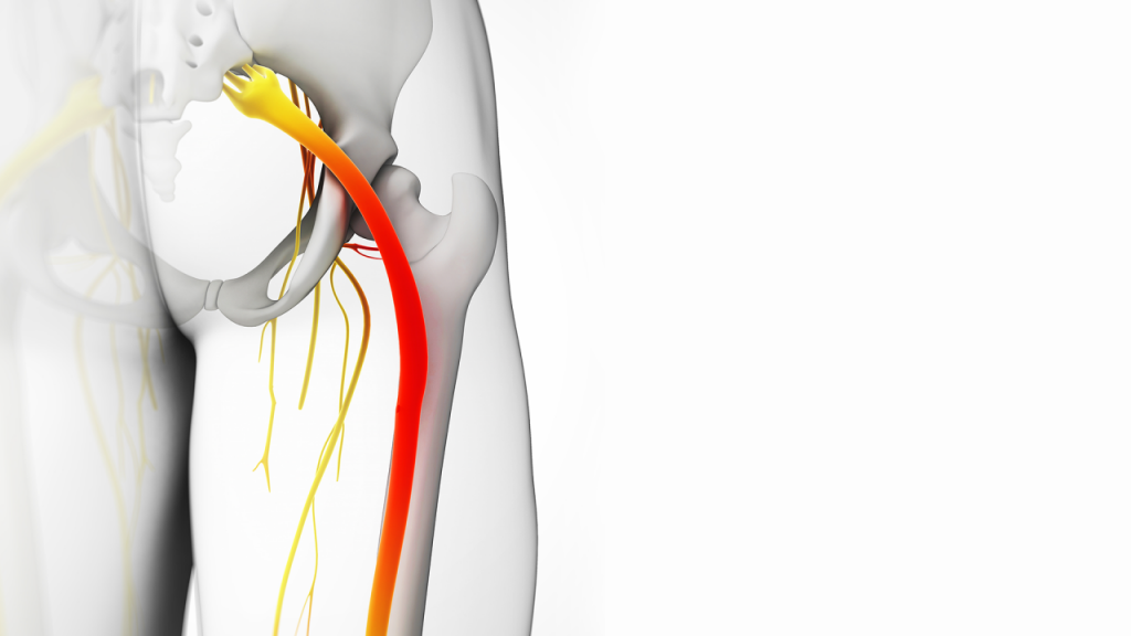 Ten en cuenta los factores de riesgo de la ciática 