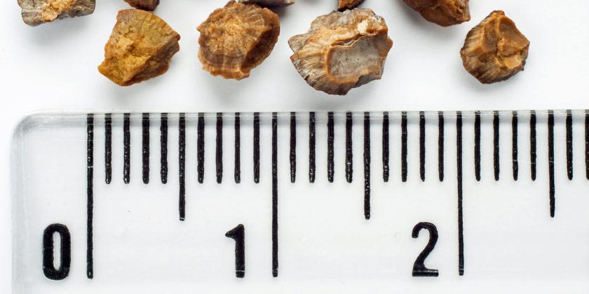 Origen del cálculo renal