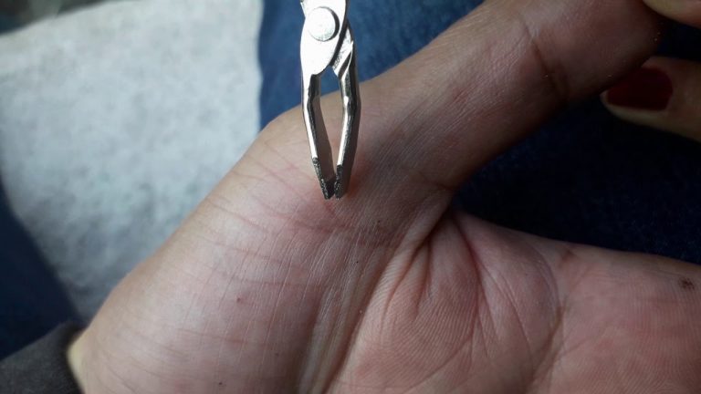 Cómo quitarse una astilla: métodos para sacarla fácilmente