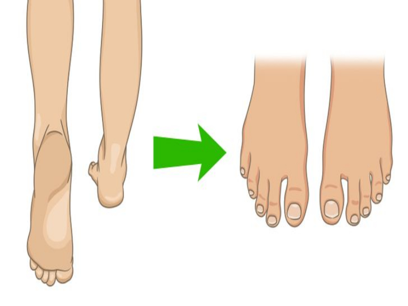 consejos  para los juanetes