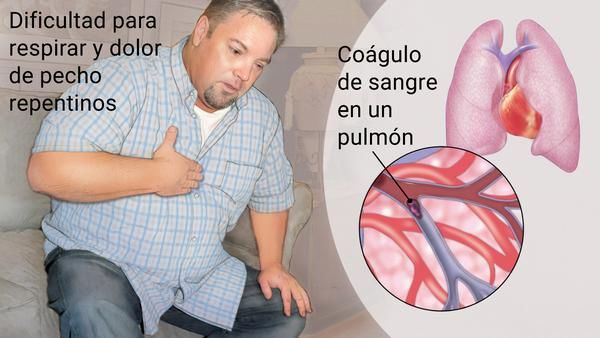 Qué es una embolia pulmonar 1 síntomas de una embolia pulmonar