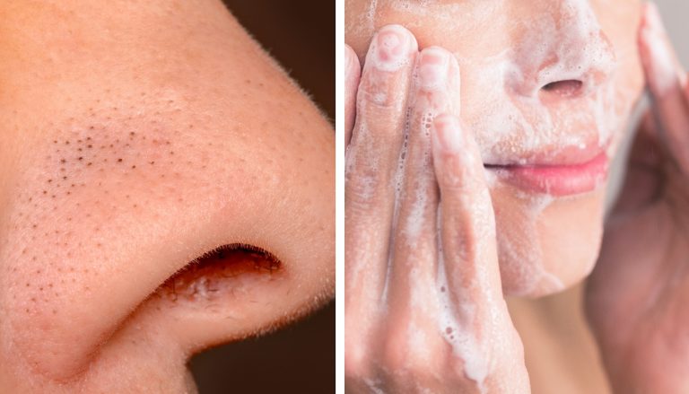 Cómo eliminar los puntos negros