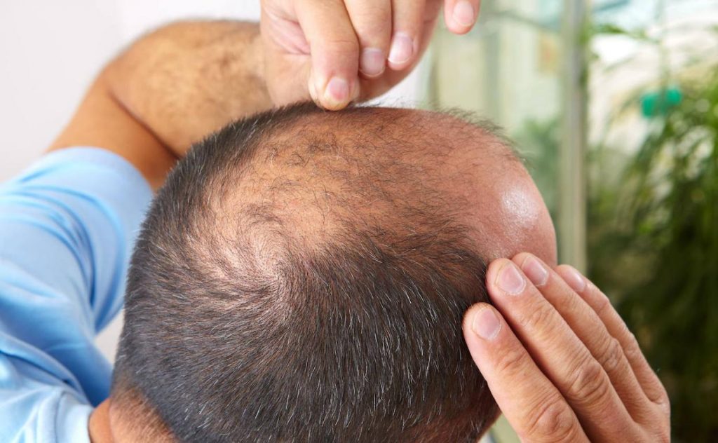 El injerto es la solución última, pero podrías convivir perfectamente con la idea de ser calvo.