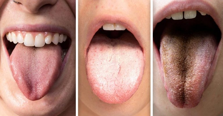 Esto es lo que dice el color de tu lengua sobre tu salud