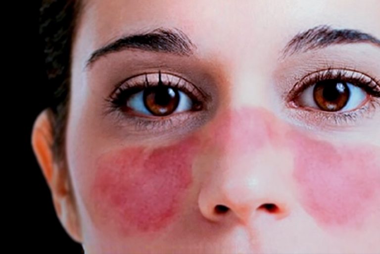 Experto: La prevalencia del lupus ha aumentado durante los últimos años