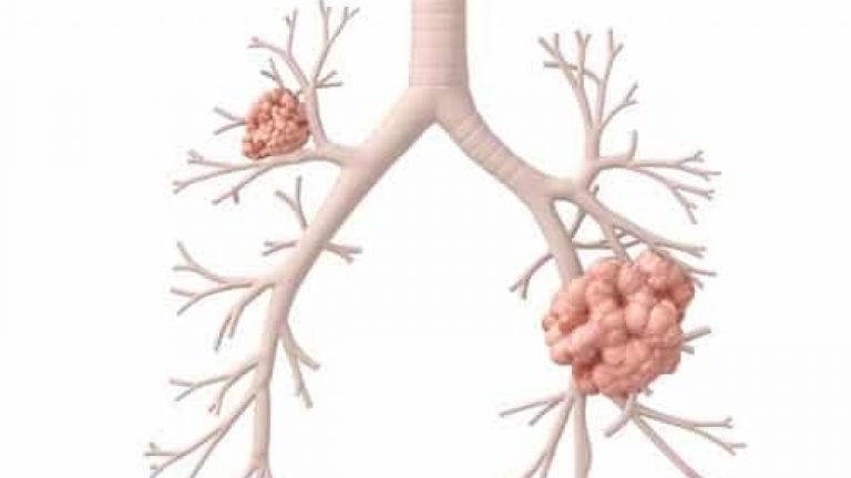 Qué es la neoplasia