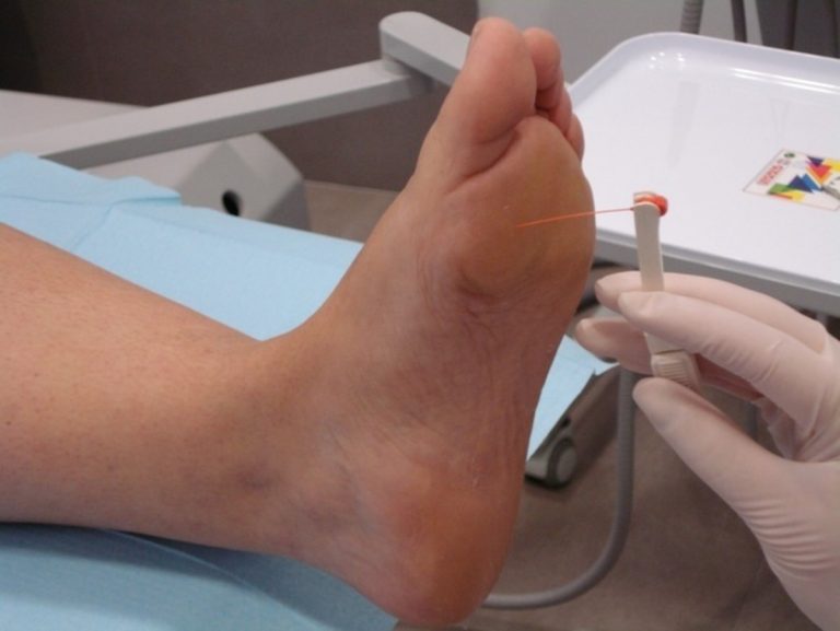 El 85% de las amputaciones por pie diabético se podrían evitar