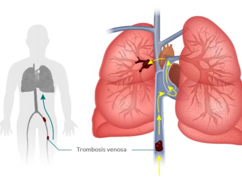que es una embolia pulmonar que es una embolia pulmonar
