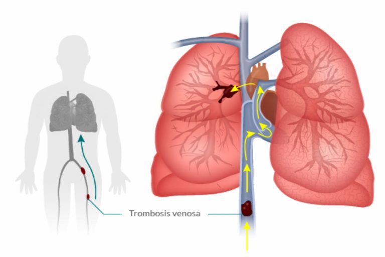 Qué es una embolia pulmonar