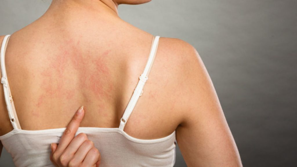 Qué es vasculitis 4 que es vasculitis