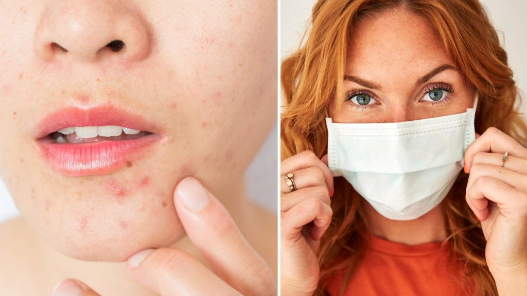 Mascarilla sucia: los problemas de salud que va a generarte 131 Acné por el uso de mascarilla