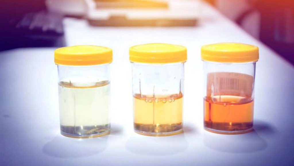 Sal: Síntomas que te avisan de que tomas demasiada 50 Color en la orina