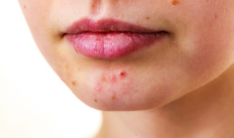 Cómo tratar el maskné y evitarlo