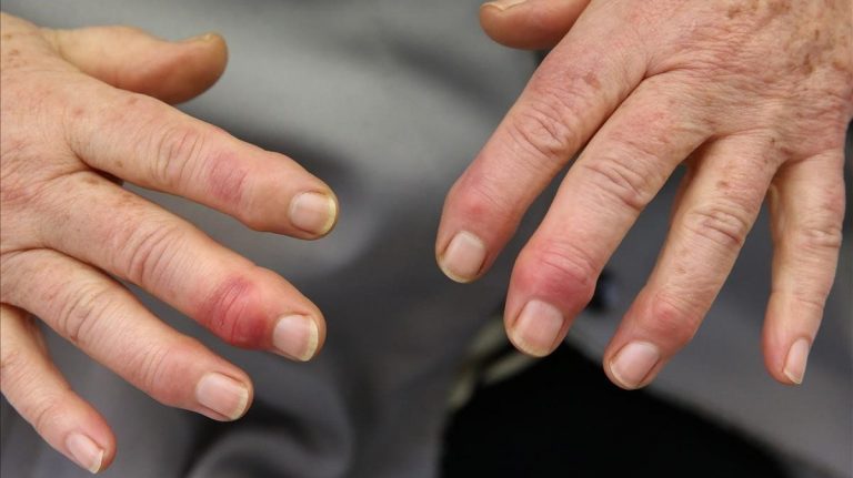 Cómo tratar los sabañones