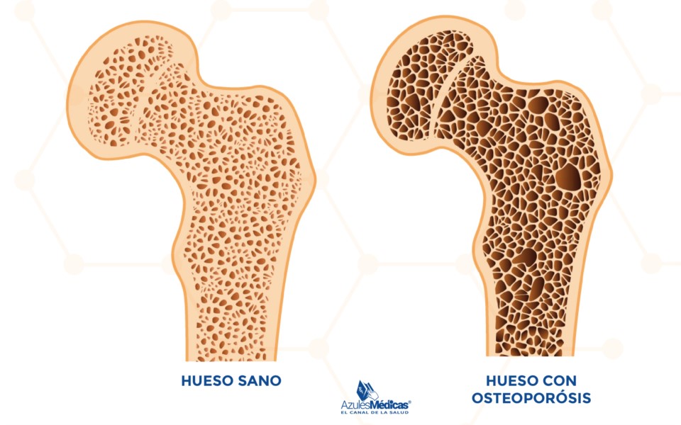 ¿Qué genera la osteoporosis?