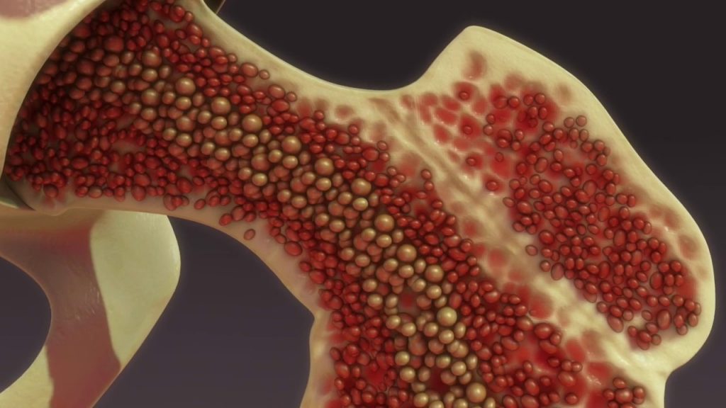 Tipos de osteoporosis