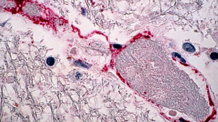 Tipos de infecciones