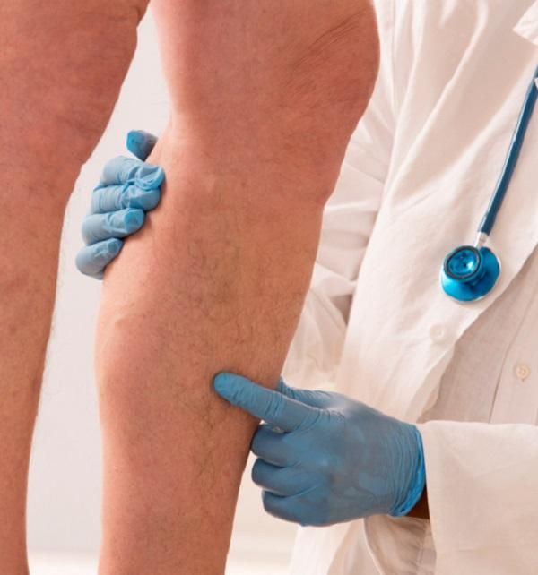 Qué es la flebitis 9 Especialista en Tratamiento de la Flebitis